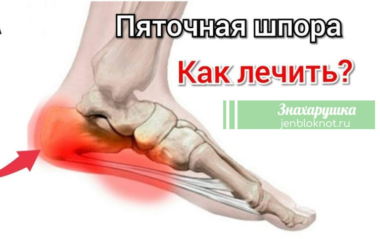 БЫСТРО ВЫЛЕЧИЛА ШПОРУ ЗА 3 ДНЯ