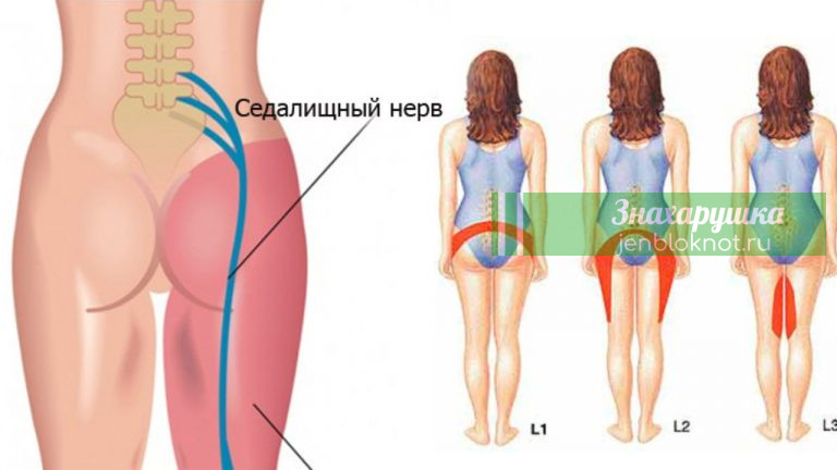 2 простых способа разблокировать седалищный нерв и унять боль