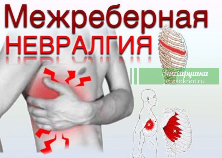ЛЕЧИМ МЕЖРЕБЕРНУЮ НЕВРАЛГИЮ