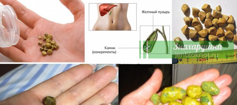 Мощный китайский секрет удаления камней из желчного пузыря всего за 7 дней