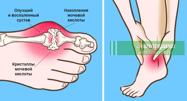 Удали мочевую кислоту и предотврати подагру и боли в суставах