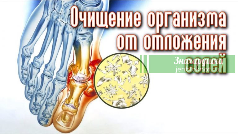 Выводим отложения солей из суставов навсегда