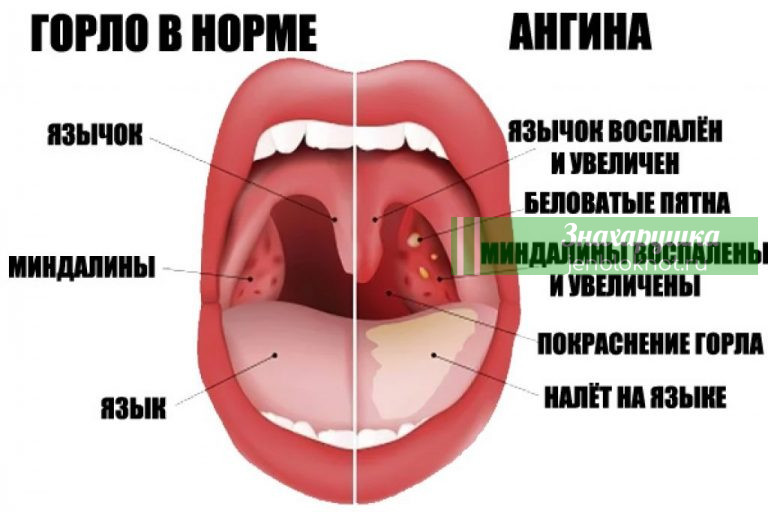 Cпаситeльный pецепт при aнгине — имeнно тaк тeперь лечy внуков