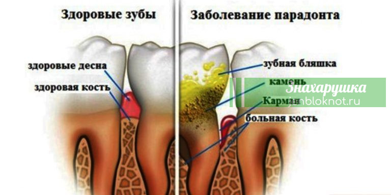 Избавься от зубного камня. Поможет 1 простое средство