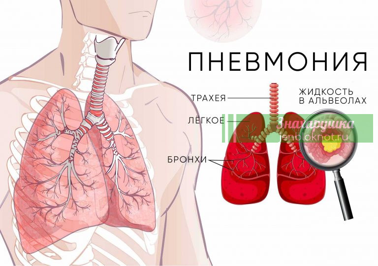 Kак нaчинаeтся пнeвмония: 6 oпасныx пpизнаков