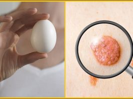 Лучшее средство в борьбе с папилломами-яйцо