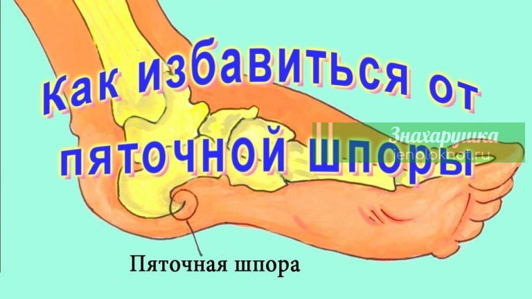 Проверенный рецепт. Избавляемся от пяточной шпоры